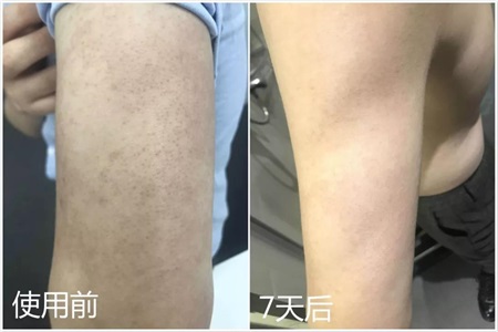 腿上有鸡皮肤怎么办？选择这款精华乳让大腿变光滑