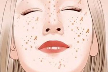 女性激光祛斑会反弹吗，医美后五个注意事项