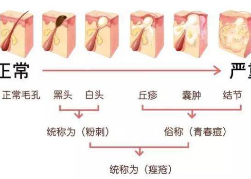 脸上长痘痘怎么调理？做好这三点让痘痘远离你