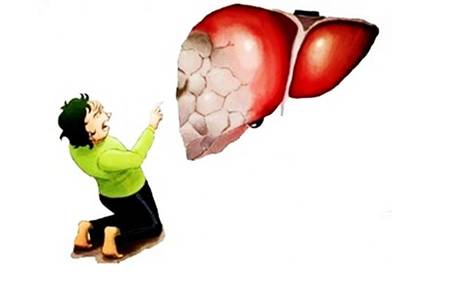 脂肪肝如何治疗和调养，脂肪肝患者要做这五件事情