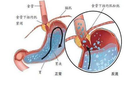 慢性胆汁反流性胃炎是怎么回事 反流性胃炎的症状及治疗方法大全