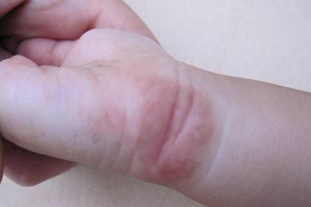 水肿是什么原因引起的？4种方法让你马上消除水肿