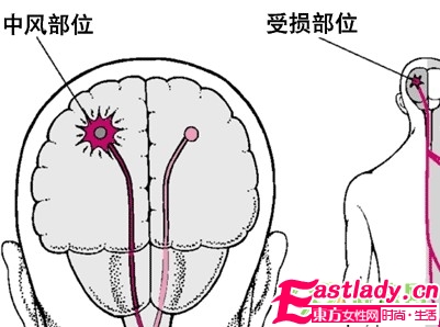 中风急救宜用的方法
